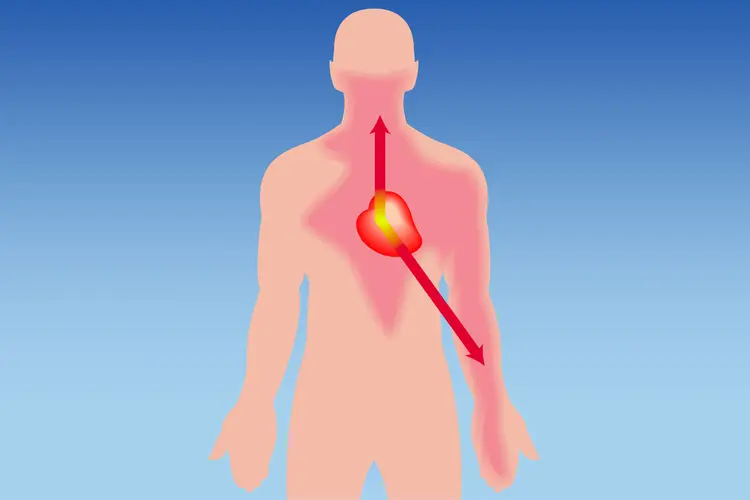 Angina Management