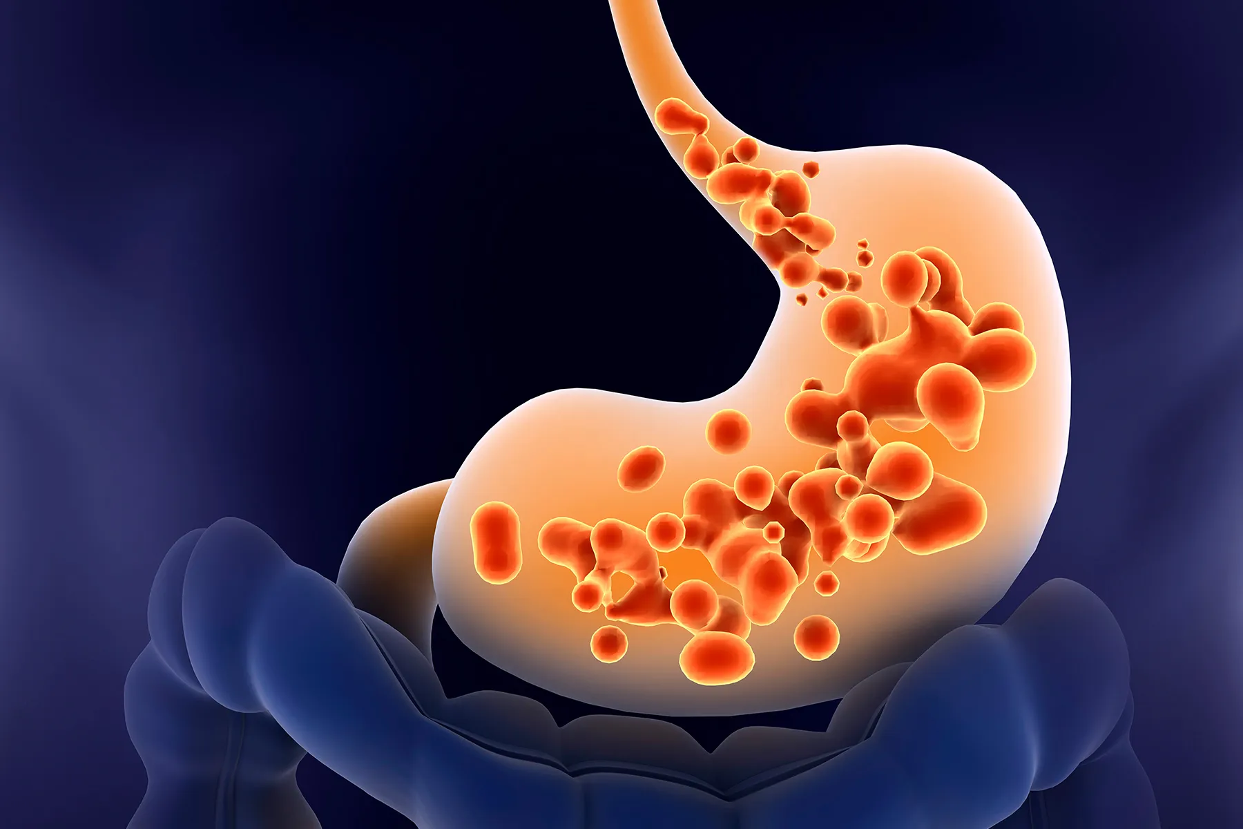 Acid Reflux & GERD Management