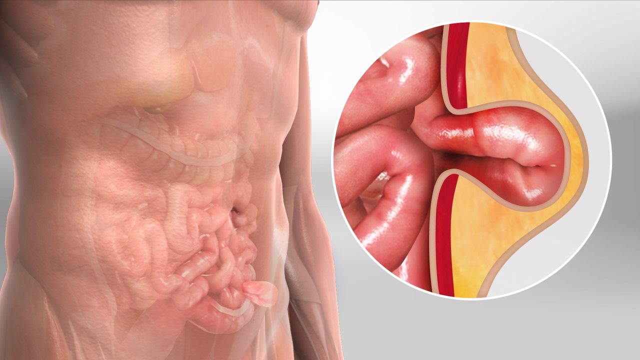 Hernia Treatment