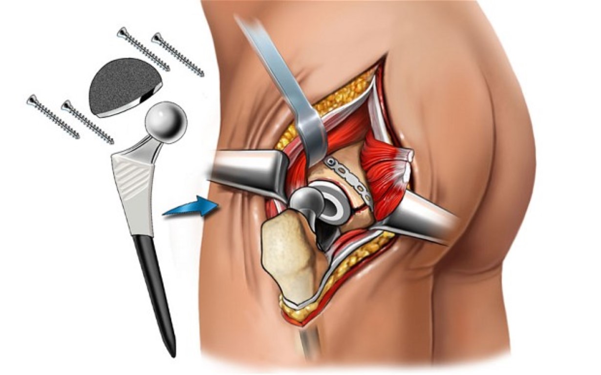 Hip Replacement Surgery