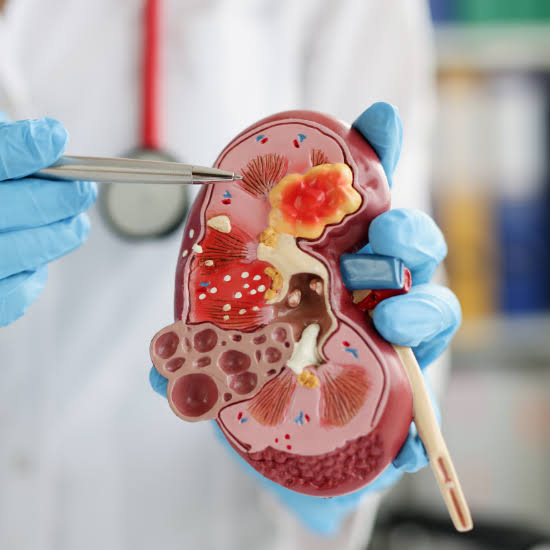 Kidney Stone Treatment