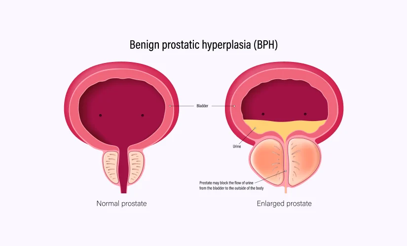 Benign Prostatic Hyperplasia (BPH) Treatment