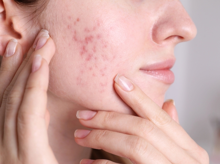 Acne & Acne Scar Treatment